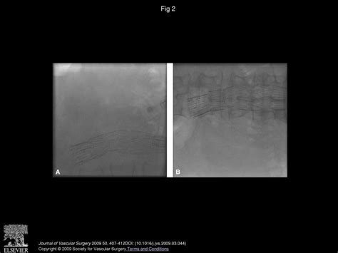 Fluoroscopic Roentgen Stereophotogrammetric Analysis FRSA To Study