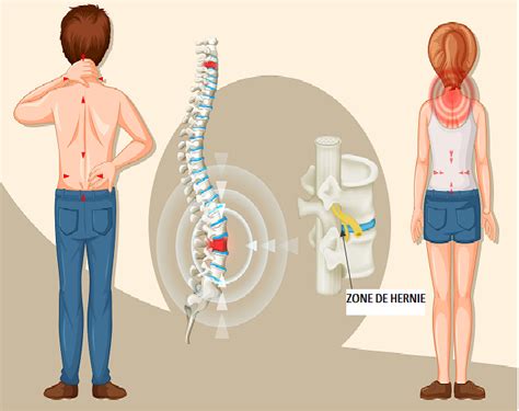 Hernie Discale Comment La Traiter Par Lost Opathie Blog Sant