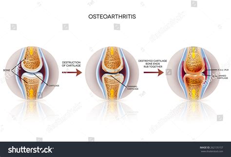 Osteoarthritis Detailed Illustration From Healthy Joint To Damaged