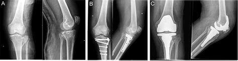 A B And C Schatzker Type Ii Tibial Plateau Fracture With Extensive