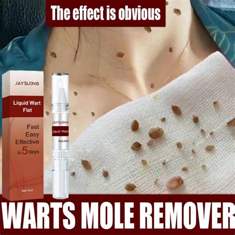 Wart Removal Liquid Pen Ubat Ketuat Buang Tahi Lalat Wart Treatment