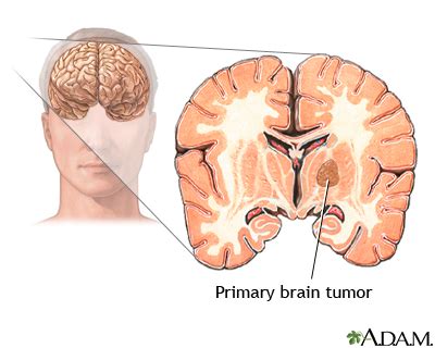 Primary Brain Tumour | Brain Tumour Surgery