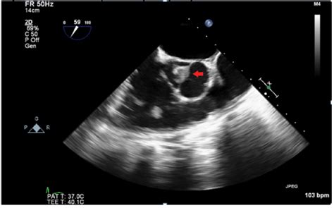 Tee 2 D Image Showing A Large Vegetation On The Aortic Valve Download Scientific Diagram