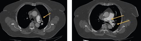 The Akura Thrombectomy Catheter System for the Treatment of VTE ...