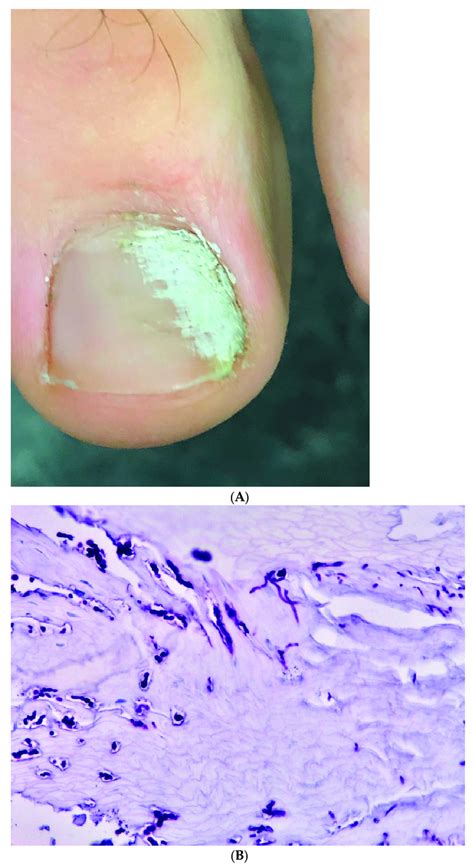 Post Traumatic Single Digit Onychomycosis Of The Big Toe Due To Download Scientific Diagram