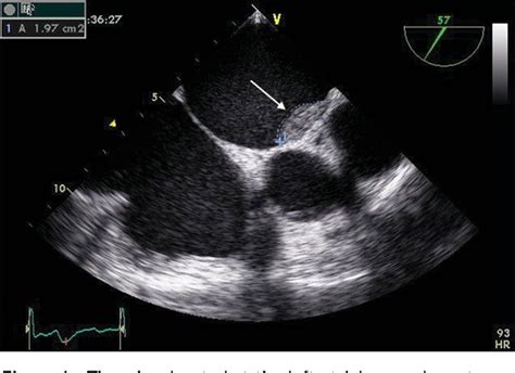 Figure 1 From Left Atrial Appendage Can Still Cause Clinical Events