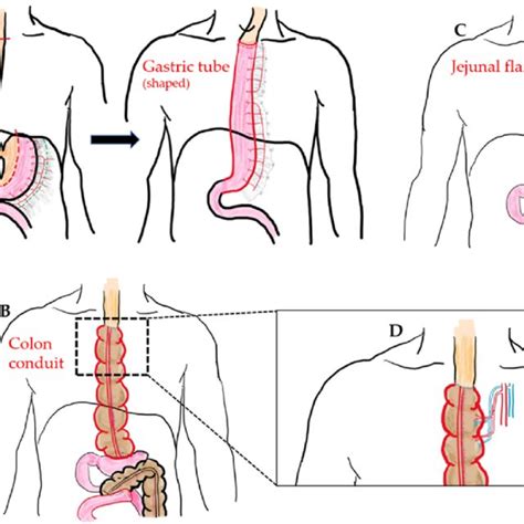 A Mckeown Esophagectomy Dotted Line Resection Margin And Gpu