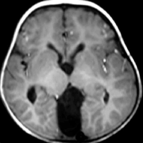 The preoperative of MRI image showed a cyst lesion at the suprasellar ...