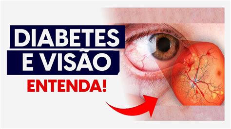 Por Que A Diabetes Pode Afetar A Vis O Entenda Dr Gustavo