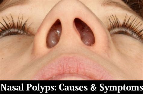 Nasal Polyps Causes Symptoms And Diagnosis Diagnosis Symptoms