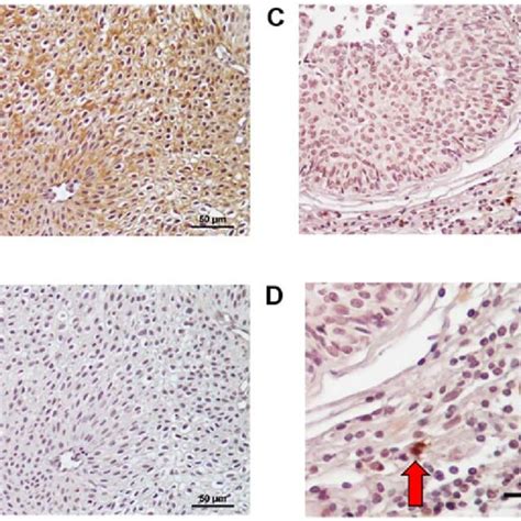 Expression Levels Of PD L1 In Bladder Cancer Specimens PD L1 Was