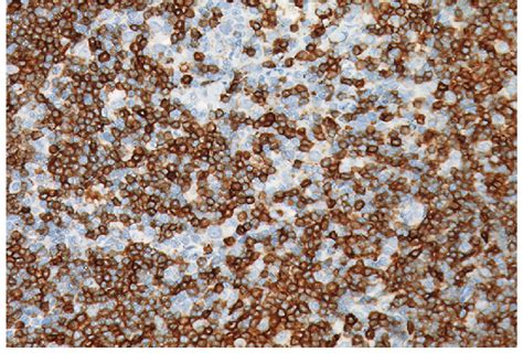 Cervical Lymph Node Histopathology Ihc Showing Cd Positivity