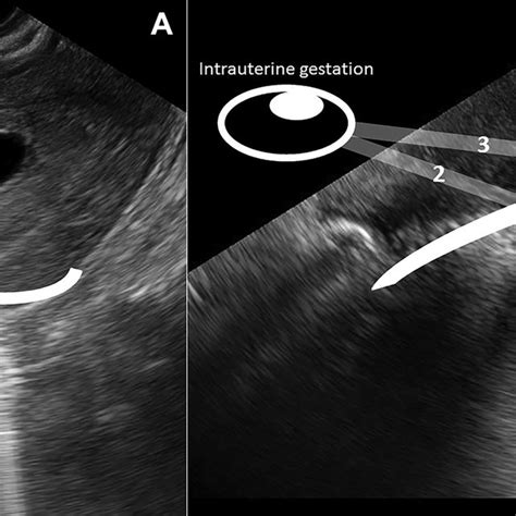 Hemoperitoneum From Ruptured Heterotopic Pregnancy Covering Ovarian