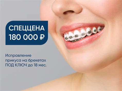 akciia na ustanovku breketov  moskve ustanovka breket sistemy gemini