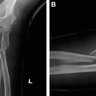 Plain radiographs demonstrating a fracture of proximal radius ...