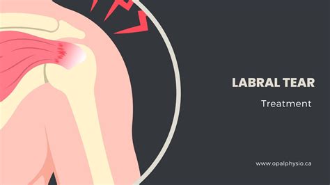 Labral Tear Physiotherapy Treatment