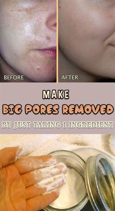 How To Get Rid Of Large Pores Just By Using 1 Ingredient Beauty Top Ideas Big Pores Big