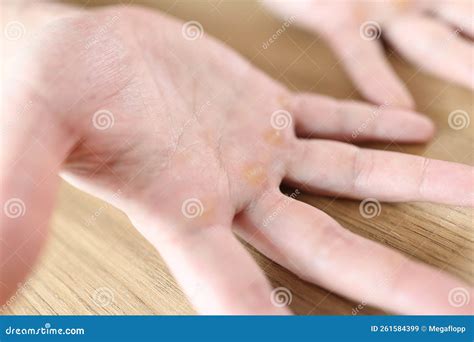 Calluses At Distal Palmar Surface Of Hands Stock Image Image Of