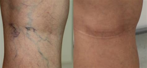 Broken Veins Thread Veins London Mole Removal