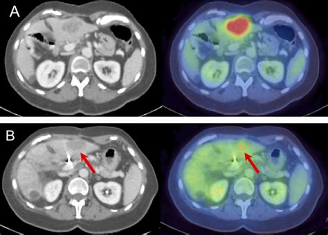 Use Of Fdg Positron Emission Tomography Pet Ct In Response Assessment