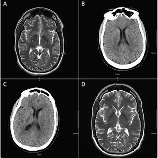 Imaging series by admission. (A) Unremarkable MRI brain on the first... | Download Scientific ...