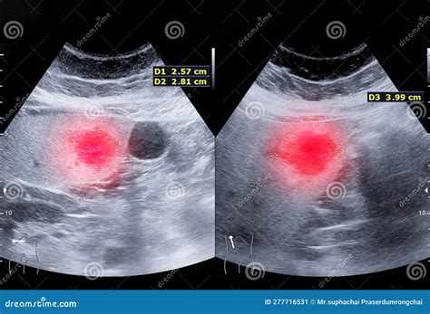 Ultrasound Upper Abdomen Showing Liver And Gall Bladder For Screening