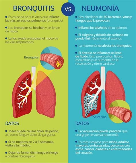 Cuadros Comparativos Entre Pulmon A Y Bronquitis Cuadro Comparativo