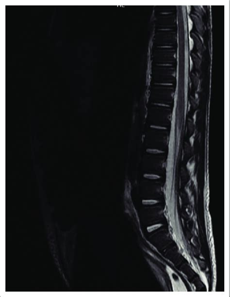 Sagittal T Weighted Magnetic Resonance Imaging Sequence Of The Lower