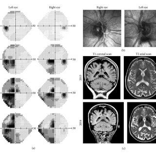 A B Left And Right Goldmann Visual Fields Showing Central