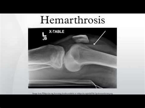 hemarthrosis youtube