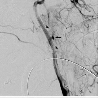 Left Internal Carotid Artery Angiogram Demonstrating Spasm At The Level