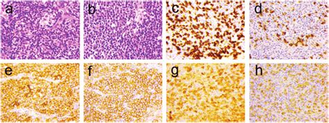 Immunohistochemical Staining Of Lymph Nodes From Biopsy A Reactive