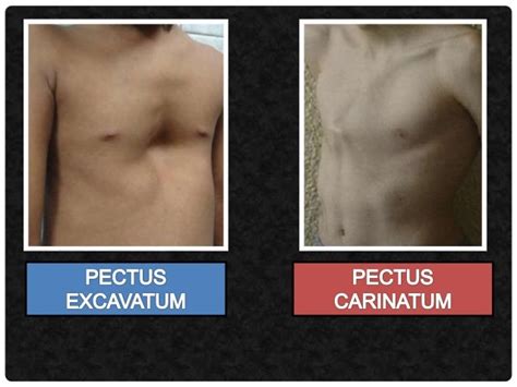 Pectus Excavatum And Pectus Carinatum Pectus Excavatum Respiratory | Porn Sex Picture