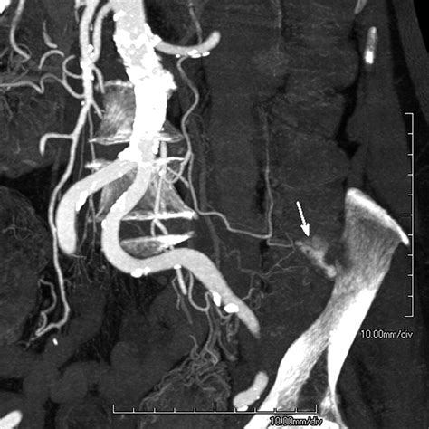 Empiric Embolization Of A Diverticular Bleed With Ct Angiographic