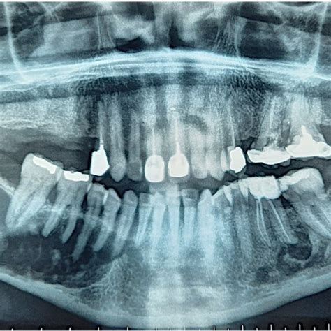 Panoramic Radiograph Well Defined Multilocular Radiolucent Image