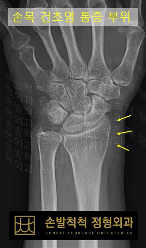 손발척척 정형외과 수술센터 수술센터 수술센터 힘줄염수술 드꿰르뱅씨병 수술손목건초염수술
