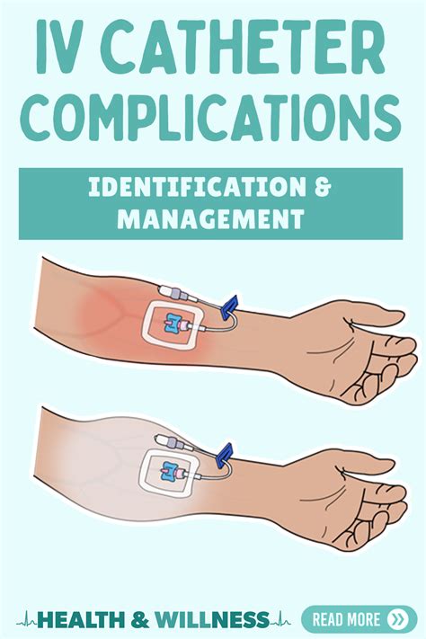 Iv Infiltration And Other Iv Catheter Complications Identification And