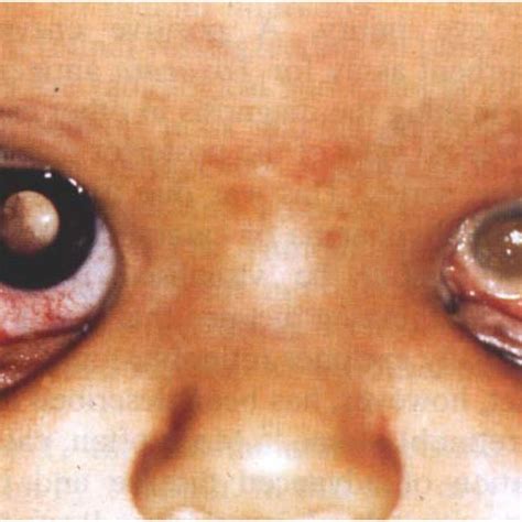 PDF Presentation Of Retinoblastoma As Phthisis Bulbi