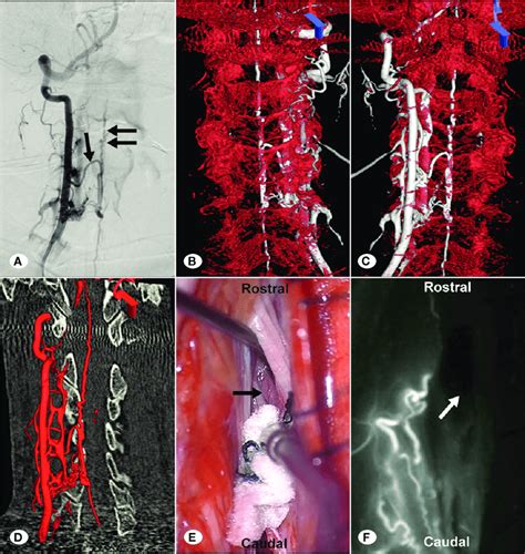 A 65 Year Old Man Presented With Cervical Spinal Dural Arteriovenous