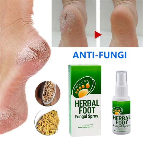 Herbal Beriberi Spray Anti Fungal Infection Onychomycosis Blisters