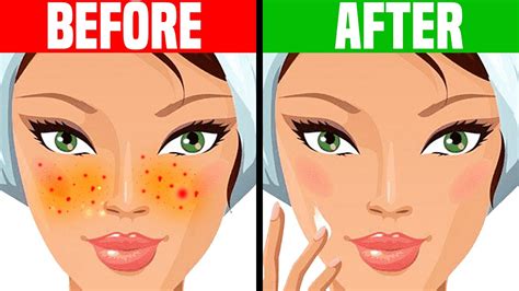 How To Get Rid Of Acne Overnight Youtube