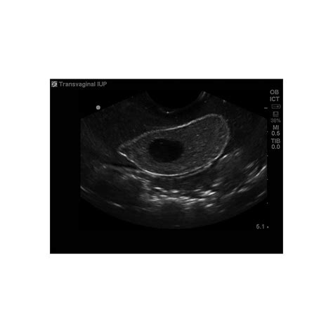 Transvaginal Ultrasound Training Model Intrauterine And Ect