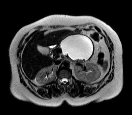 Mucinous Cystadenoma Of The Pancreas Radiology Reference Article