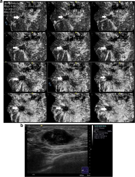 Comparative Study Of Automated Breast D Ultrasound And Handheld B