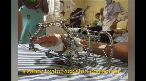 Neglected Club Foot Deformity Treated With Ilizarov Assisted Correction Youtube