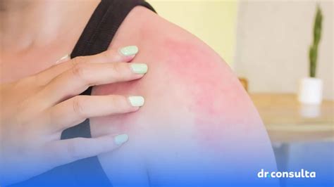Como Eliminar Alergia Do Calor - Você tem alergia ao calor? Saiba o que fazer para aliviar | Blog dr ...