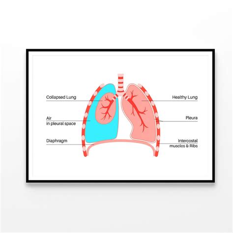 pneumothorax anatomical illustration print premium poster high quality