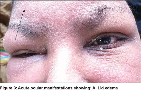 Study Of Ocular Manifestations Of Stevens Johnson Syndrometoxic