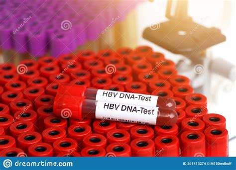 HBV DNA Test Test To Look For Abnormalities From Blood Stock Photo