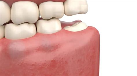 6 Key Signs You May Have An Impacted Wisdom Tooth